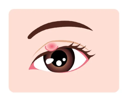 Not all “lumps” on the eyelid are styes!