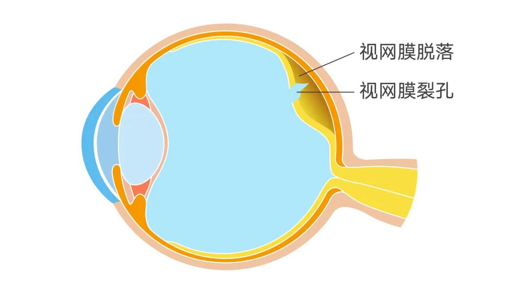 眼前频繁出现“飞蚊”？你的眼睛可能在“报警”！