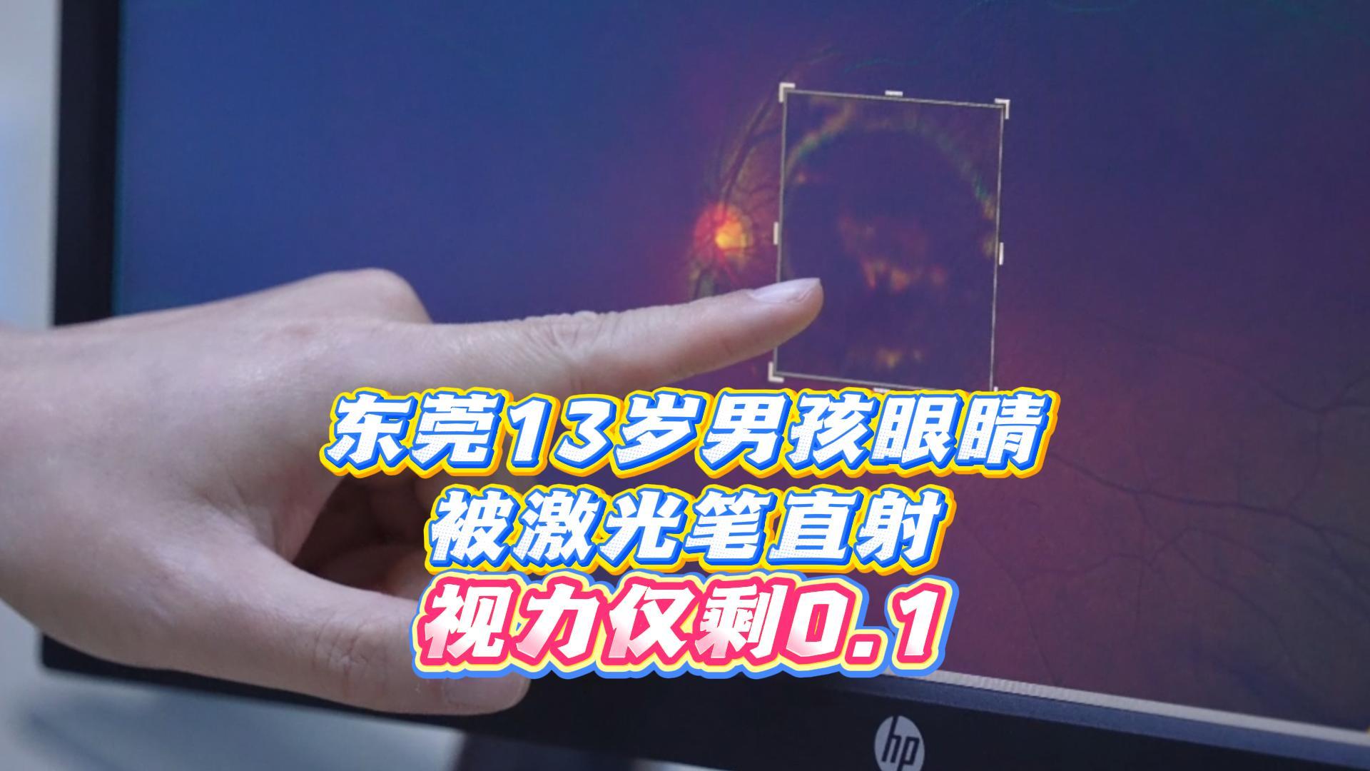 激光笔直射几秒，致13岁少年黄斑裂孔，视力下降至0.1！近日，广东电视台《DV现场》栏目就此采访了东莞爱尔眼科医院眼底外伤科主任王虎，他指出，因激光笔照眼导致的不可逆损伤案例时有发生，需引起家长的高度警惕。#黄斑裂孔 #东莞爱尔眼科